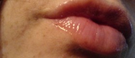 Dark spots on face