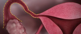 ZIFT: A lesser known assisted reproduction technique