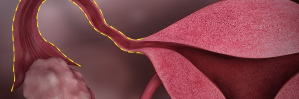 ZIFT: A lesser known assisted reproduction technique