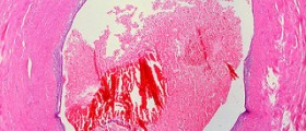 How to get pregnant with endometriosis
