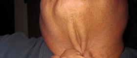 How to get rid of neck fat