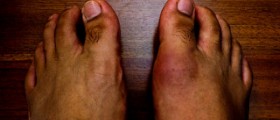 Gout: the agony of the feet