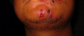 How to get rid of fever blisters