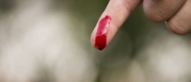 Blood disorders: hemophilia disease