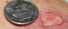 Benign finger tumors