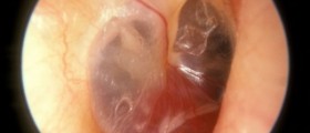 Benign neck tumor