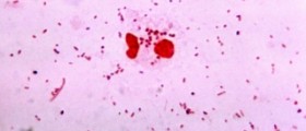 Gonorrhea symptoms