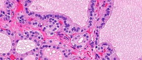 Graves' disease symptoms