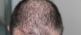 Hair transplant : the real truth !