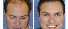 Permanent hair transplant method