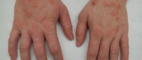 Dermatitis treatment for hands