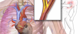 Angina: treatment and diet