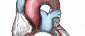 Congestive heart failure end stage