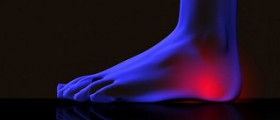 Heel spur: calcaneal spur treatment