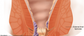 Hemorrhoids treatment methods