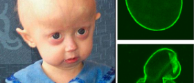 Therapy for progeria