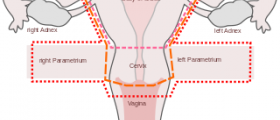 Removing ovaries with hysterectomy prevents ovarian cancer?