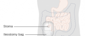 Complications after ileostomy