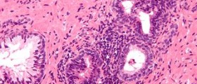 Chronic nonbacterial prostatitis