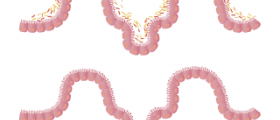 Viral intestinal infection