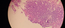 Iron deficiency anemia