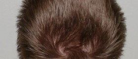 Itchy flaky scalp