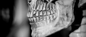Jaw surgery cost