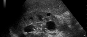 Benign cyst in kidney