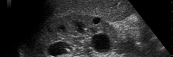 Benign cyst in kidney