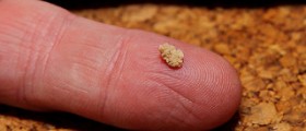 How to dissolve kidney stones