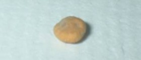 Kidney pain! - how to pass kidney stones naturally at home