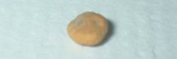 Kidney pain! - how to pass kidney stones naturally at home