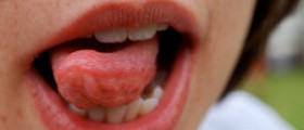 Warts on tongue