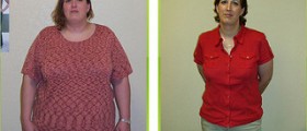 Lap band surgery: calorie diet