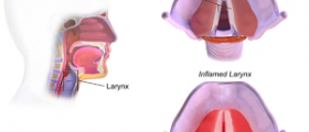 About chronic laryngitis