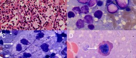 Chronic myeloid leukemia