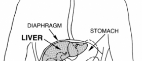 Liver cirrhosis stages