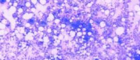 Causes, symptoms and treatment for thrombocytopenia