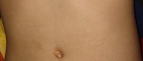 Discomfort in lower abdomen