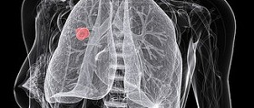 Lung cancer and its alternative treatments