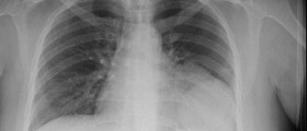 Chronic pulmonary disease