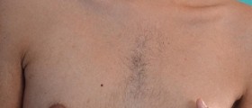 Breast lumps in men