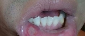 Chronic mouth ulcers