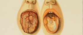 Florida: Syphilis making a comeback!