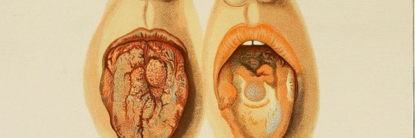 Florida: Syphilis making a comeback!