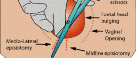 What to expect from an episiotomy?
