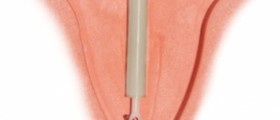 Mirena IUD side effects
