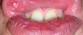 Prevention of mouth ulcers