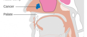 Nasal cancer symptoms