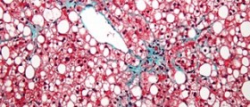 What is a fatty liver